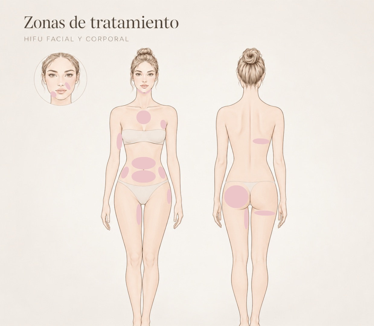 Esquema de Zonas de Tratamiento HIFU LP
